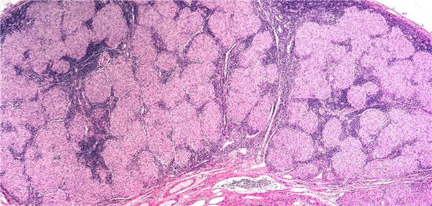 Sarkoidose: Mikroskopische Aufnahme eines vergrößerten Lymphknotens mit Granulomen.