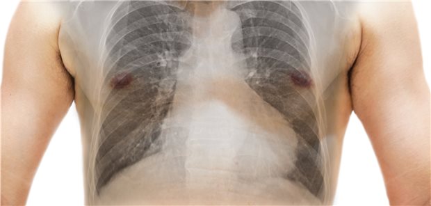 Sarkoidose kann die Ursache einer interstitiellen Lungenerkrankung sein. Aber auch andere Organe können von der granulomatösen Erkrankung betroffen sein.