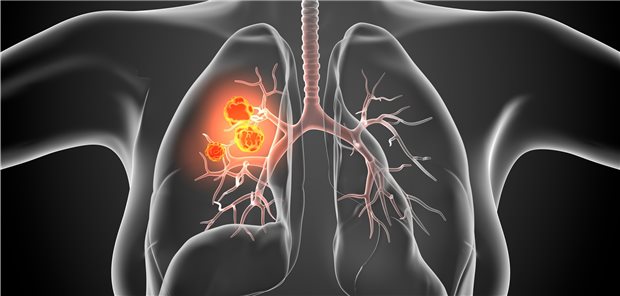 Schätzungen gehen davon aus, dass die Lungenkrebsmortalität bei Frauen in diesem Jahr in der EU um 6,5 Prozent auf 14,5/100.000 steigen wird.