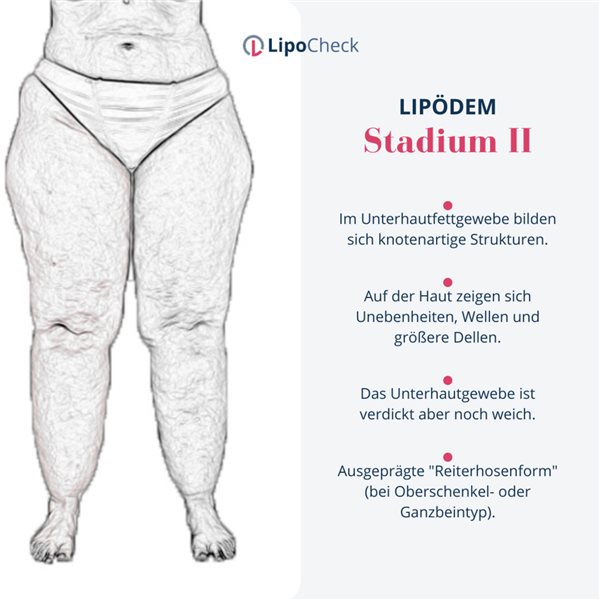 Besonderes Start-up: Lipödem-Spezialist entwickelt gemeinsam mit seinen