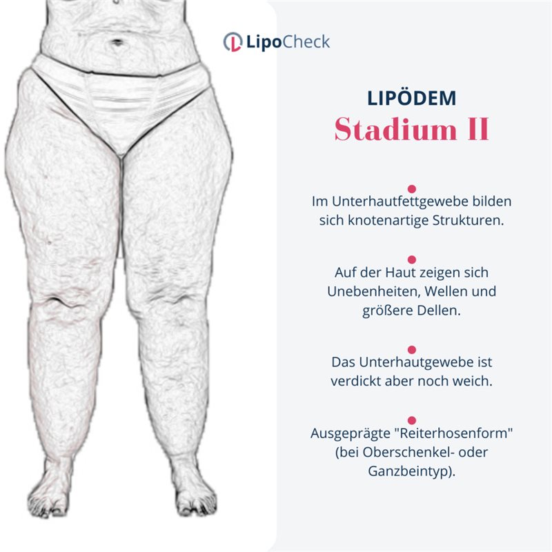 Besonderes Start-up: Lipödem-Spezialist entwickelt gemeinsam mit seinen ...