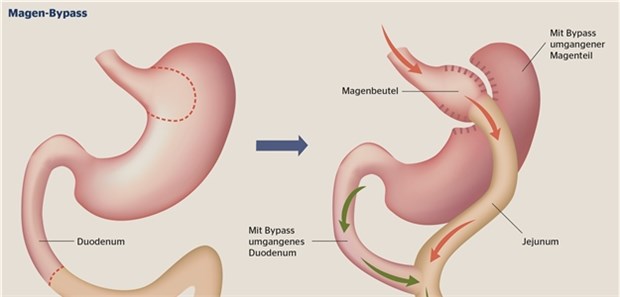 Schema einer Magenbypass-Operation: Der Roux-Y-Bypass gehört zu den häufigsten Verfahren der bariatrischen Chirurgie.