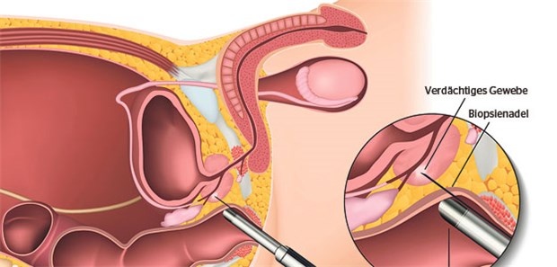 Androgenentzug erhöht kardiovaskuläres Risiko Schema einer Prostatabiopsie unter transrektaler Ultraschallkontrolle.