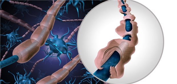 Schema einer geschädigten Myelinscheide bei MS.