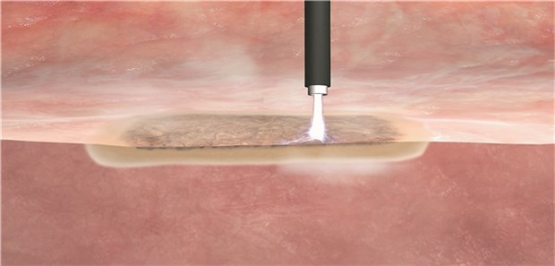 Elektrochirurgie im Einsatz bei Adipositas Schematische Darstellung der Gewebeabtragung mittels Argon-Plasma-Koagulation.