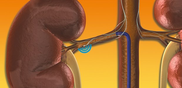 ESC würdigt Nervenverödung Schematische Darstellung der renalen Sympathikusdenervation. Bei diesem Verfahren werden mittels Spezialkatheter in der Adventitia der Nierenarterien verlaufende sympathische Nervenfasern verödet.