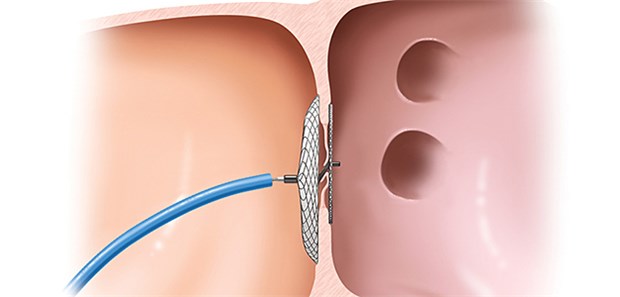 Schematische Darstellung des Verschlusses eines offenen Foramen ovale mit einem per Katheter eingeführten Occluder-System, das dann permanent vor Ort bleibt.