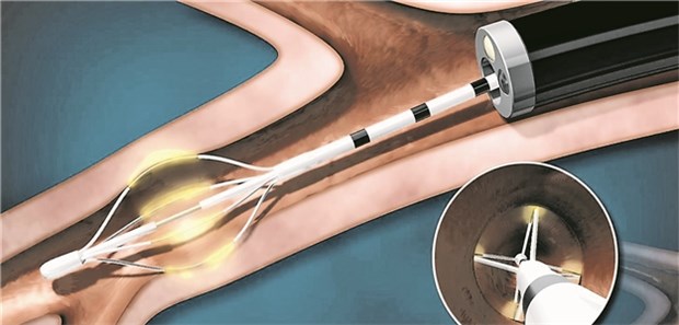 Schematische Darstellung des aktivierten Katheters bei einer bronchialen Thermoplastie. Durch Radiofrequenzwellen wird thermische Energie erzeugt.