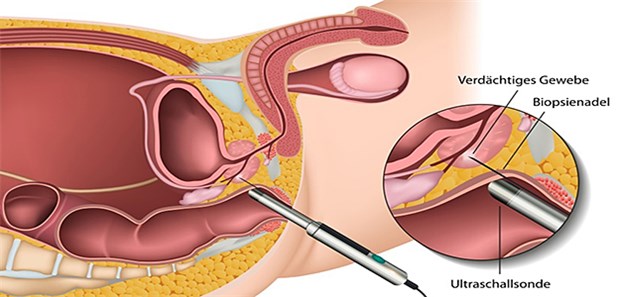 Schematische Darstellung einer Prostatabiopsie.