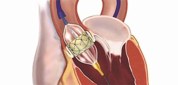 Schematische Darstellung einer TAVI: Langzeitdaten haben bisher gefehlt.