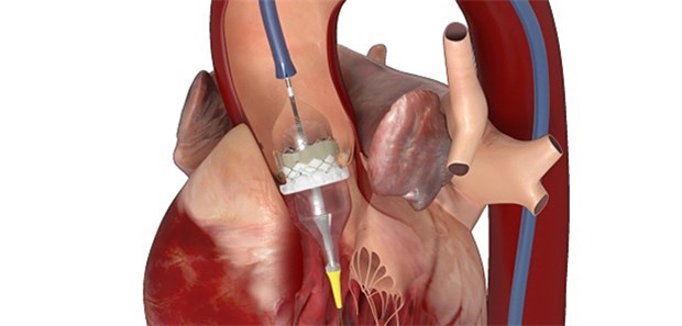 Wie haltbar sind die Herzklappen? Schematische Darstellung einer Transkatheter-Aortenklappen-Implantation (TAVI). Diese minimal invasive OP-Form wird immer häufiger eingesetzt.