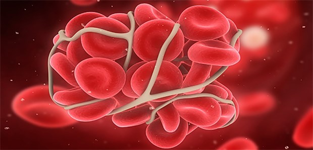 Große Menschen haben höheres Thrombose-Risiko Schematische Darstellung eines Blutpfropfens: Einer neuen Studie zufolge haben größere Menschen ein höheres Risiko für Thrombose.