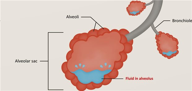 Das Forschungsteam um die Kardiologin Rosa Lillo resümiert, dass bei Patienten mit schwerer Aortenstenose vor einer TAVI die Sonografie der Lunge eine hohe Prävalenz des Lungenödems zeige. Nach dem Eingriff sinke die Prävalenz signifikant.