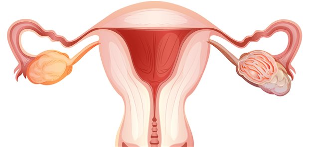 Schematische Darstellung eines Ovarialtumors.