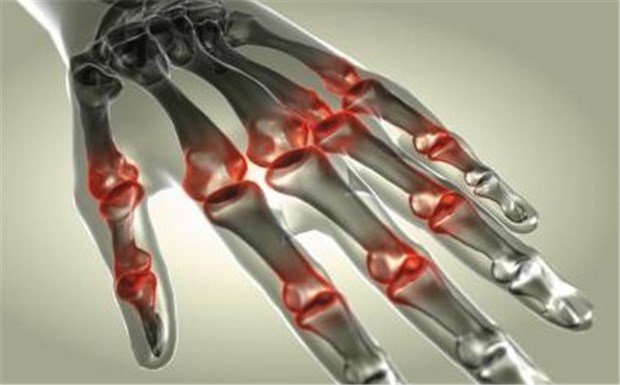 Erster Interleukin-6-Hemmer gegen Arthritis Schematische Darstellung entzündeter Fingergelenke bei Rheumatoider Arthritis.