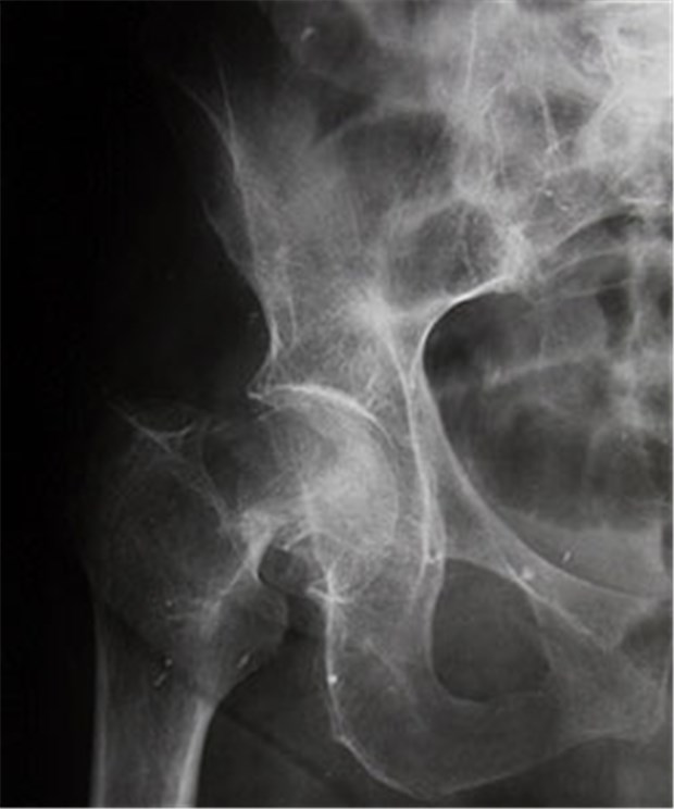 Osteoporose-Netz zieht erfolgreiche Bilanz Schenkelhalsfraktur bei Osteoporose - ein Bild, dass man im Rheinland dank des Osteoporose-Netzes seltener sieht.