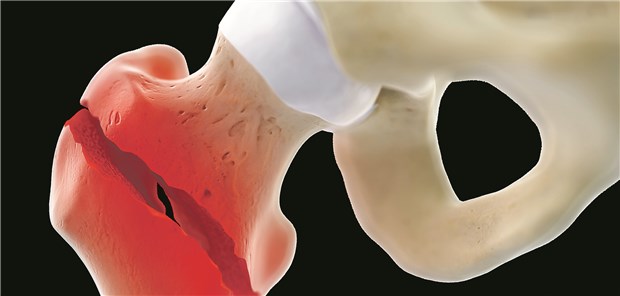 Nanokristalle beeinflussen die Knochenbildung Schenkelhalsfrakturen sind häufig durch Osteoporose bedingt. Biomoleküle beeinflussen den Prozess der Reparatur, indem sie Stammzellen aus dem Knochenmark dazu bringen, neues Knochengewebe zu bilden.