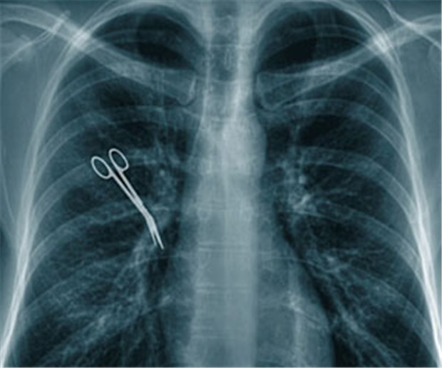 Patientenrechtegesetz wird nur GKV-Patienten nützen Schere im Brustkorb - ein schwerer Behandlungsfehler, der sicher unstrittig ist.
