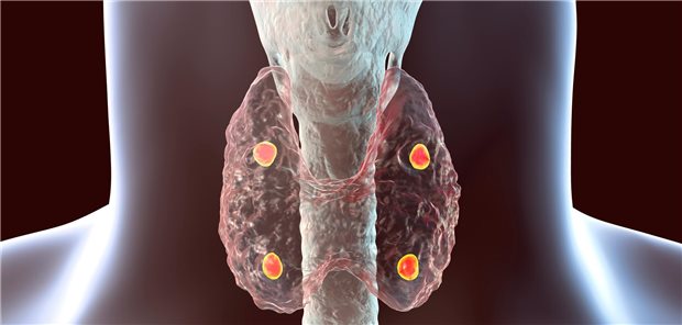 Schilddrüse mit Nebenschilddrüsen: Sind sie geschädigt, oder bei einer Op entfernt worden, droht ja ein Mangel an Parathormon (PTH). 