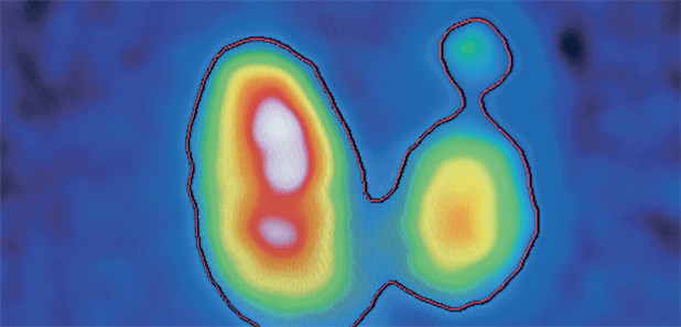 Knoten in schilddrüse entdeckt