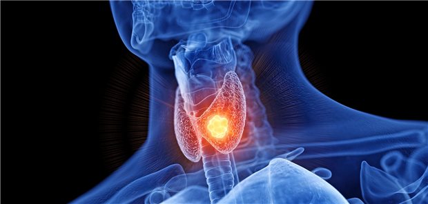 Schilddrüsenkarzinom: Mit Selpercatinib steht nun ein hochselektiver Inhibitor der RET-Tyrosinkinase für die Behandlung zur Verfügung.