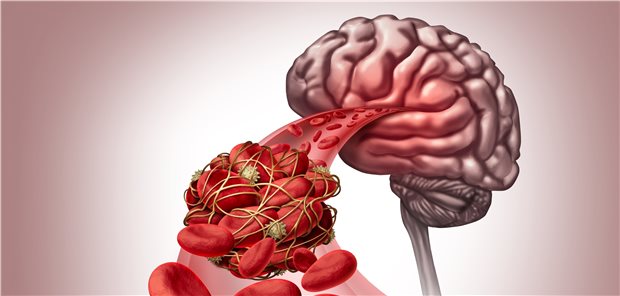 Schlaganfall: Gibt es wegen der Pandemie weltweit aufgrund verschobener Operationen weniger davon Betroffene?