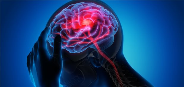 Schlaganfall vorbeugen durch Karotisstent-Implantation oder Thrombendarteriektomie?