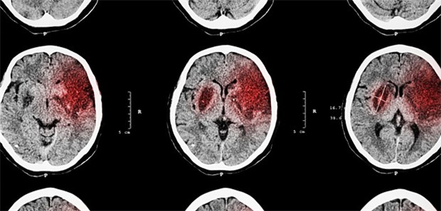Schlaganfall (rot) im CT: Der ABC-Score zum Schlaganfallrisiko berücksichtigt auch Biomarker.