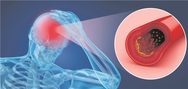 Schlaganfallversorgung: Intraarterielle Lyse nach der Thrombektomie scheint sich zu lohnen.