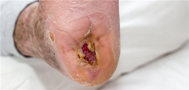 Diabetischer Fuß mit Ulkus