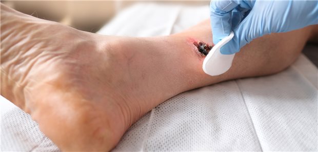 BVMed warnt vor Produktausfällen in der Wundversorgung Schlecht heilende Wunden sind eine Herausforderung. Wundverbände mit zusätzlichen therapeutischen Eigenschaften versprechen Hilfe – haben allerdings auch ihren Preis.