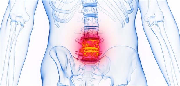 Schmerz ist eine häufige Komorbidität von axialen Spondyloarthritis (axSpA)-Patientinnen und Patienten und damit neben den sozialmedizinischen Faktoren eine mögliche Ursache für eine Difficult to Treat-axSpA. (Symbolbild)