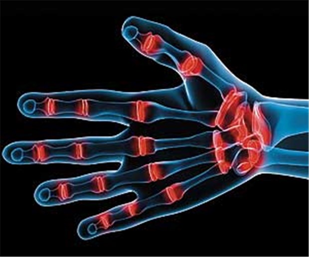 Schmerzen - die tägliche Last vieler Rheumatikerinnen Schmerzen gehören für viele Frauen mit Rheumatoider Arthritis leider zum Alltag.