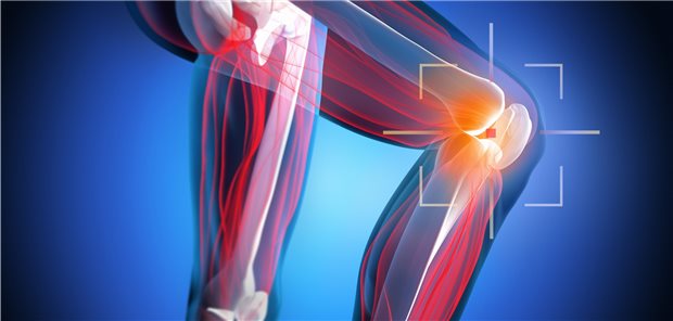 Schmerzen im Knie: Ein spezielles Krafttraining soll Arthroseschmerzen lindern und die Beweglichkeit fördern. Eine randomisierte Studie aus den USA weckt gewisse Zweifel an der langfristigen Wirksamkeit eines intensiven Trainings.
