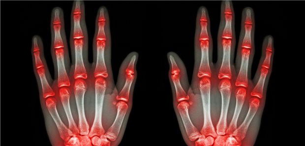 Schmerzen in den Gelenken – ist es eine rheumatische Erkrankung? Die Diagnose wird in Deutschland noch zu oft zu spät gestellt.