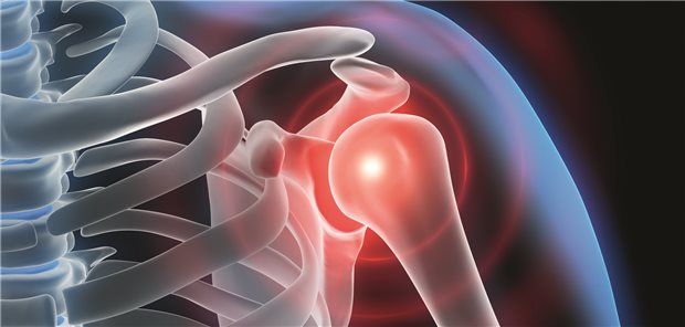 Schmerzen in der Schulter? Der Grund könnte eine Kalkschulter sein.