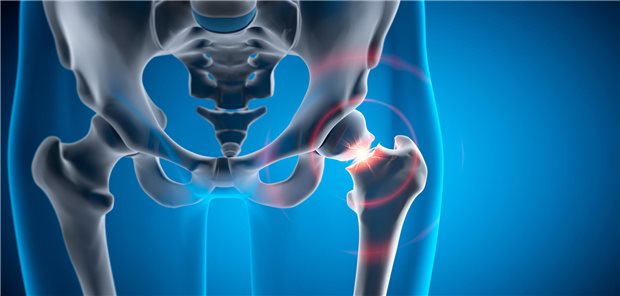 Dreidimensionale medizinische Illustration einer Fraktur des linken Hüftgelenks.