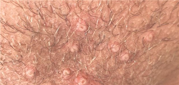 Wann auch Affenpocken eine Diagnose sein könnten – und wie Sie dann vorgehen Bilder aus der Praxis (siehe unten stehende Kasuistik): Multiple Hautläsionen im Genitalbereich am Tag 3 der Erkrankung.