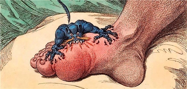 Schmerzhaft und entzündet: Karikatur eines Gichtanfalls aus dem 18. Jahrhundert.
