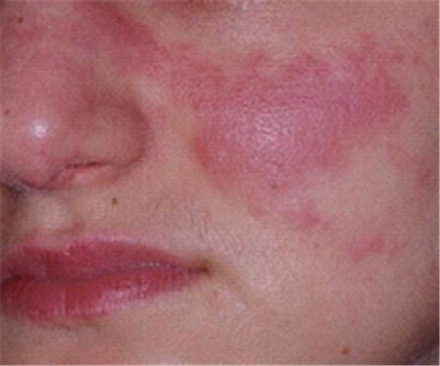 Die Sonderstellung des systemischen Lupus Schmetterlingserythem bei einer Patientin mit SLE.