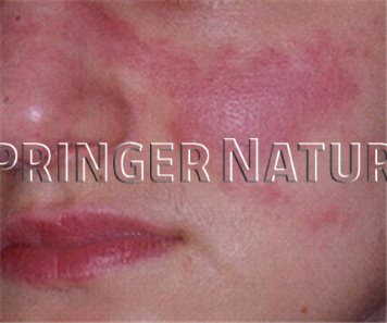 Die Sonderstellung Des Systemischen Lupus die-sonderstellung-des-systemischen-lupus