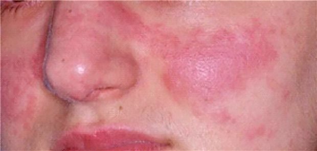 Schmetterlingserythem bei einer Patientin mit SLE.