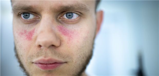 Schmetterlingsförmige Rötung im Gesicht: Typisch bei vielen Lupus-Patienten.