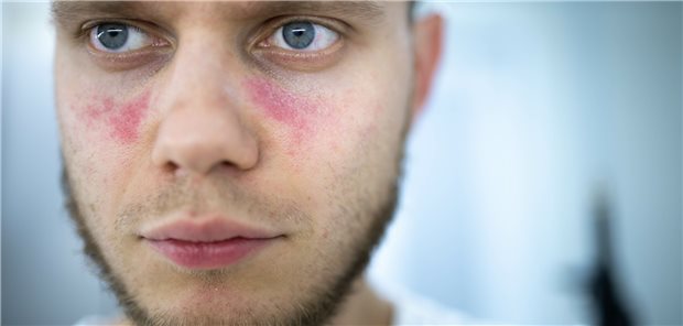 Schmetterlingsförmige Rötung im Gesicht: Typisch bei vielen Lupus-Patienten. (Symbolbild mit Fotomodell)