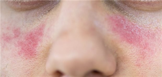 Schmetterlingsförmige Rötung im Gesicht: Typisch bei Lupus-Patienten. Ein neues Biologikum bessert auch Hautsymptome (Symbolbild mit Fotomodell).