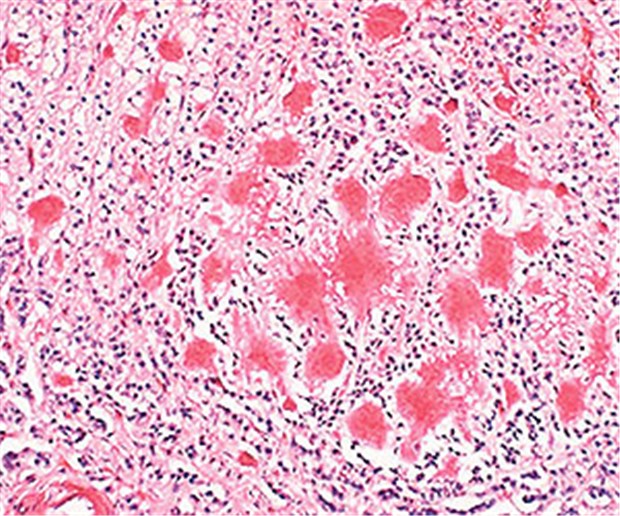 Schwermetall könnte Alzheimer beschleunigen Schnittbild: Beta-Amyloidablagerungen im Hirn bei Alzheimer.
