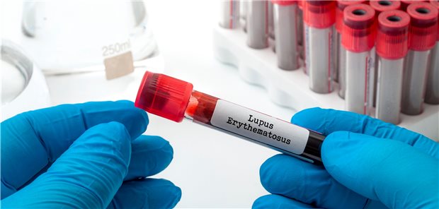 Schon länger richten Rheumatologen den Blick auf zelluläre und molekularbiologische Zusammenhänge. Allein beim SLE werden über 70 verschiedene Targets erforscht.
