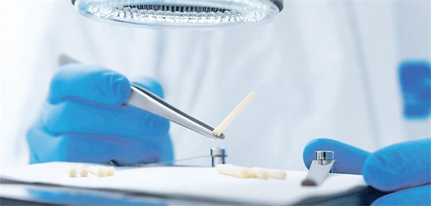 So werden aus den Knochen der Patienten Schrauben Schrauben aus Spenderknochen: Das Material schrumpft bei Sterilisation und quillt im Körper wieder auf.