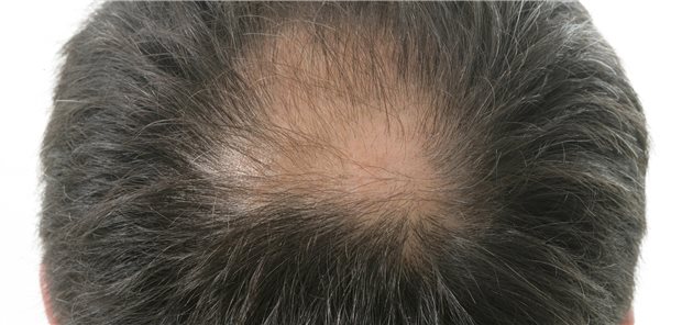 Schütteres Haar oder Haarausfall? Einer Studie zufolge ist Haarausfall ein häufiges Symptom bei Long-COVID.
