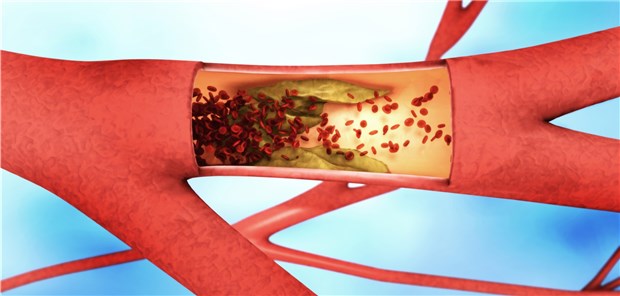 Schützt Rivaroxaban plus ASS auch vor Hirninfarkt-Rezidiven? MAN AT MOUSE / stock.adobe.com